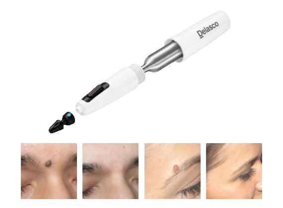 FrostAway™ Cryo Pen