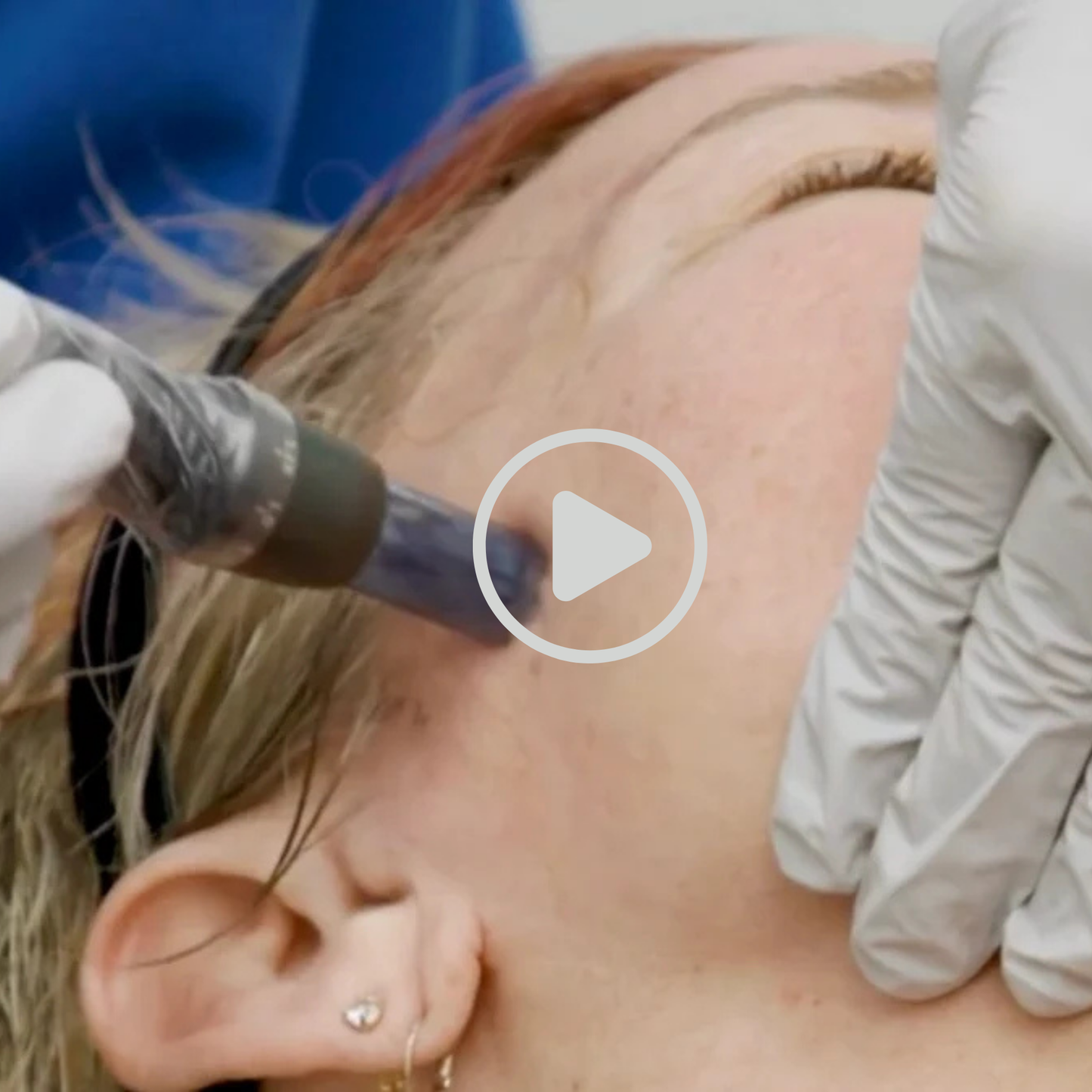 Microneedling 101 Online Tutorial
