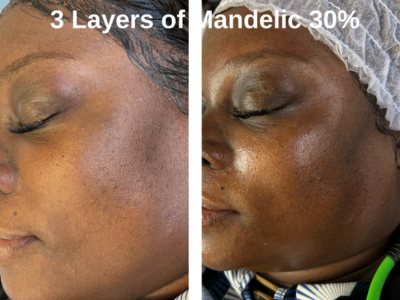 3 layers of Mandelic 30% chemical peel